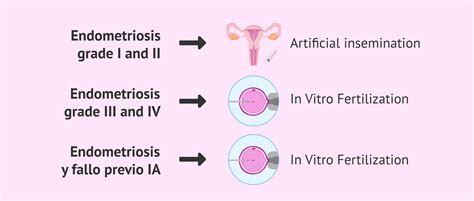 endometriosis and fertility treatment
